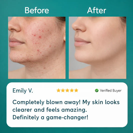 Balabu - Hormonal Hair Remover PRO